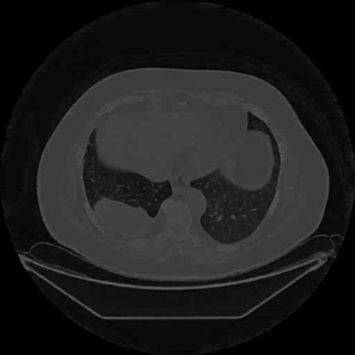 Reconstructed NATIVE CT scan (cycle consistency)