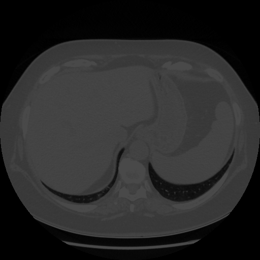 Original NATIVE CT scan (input)