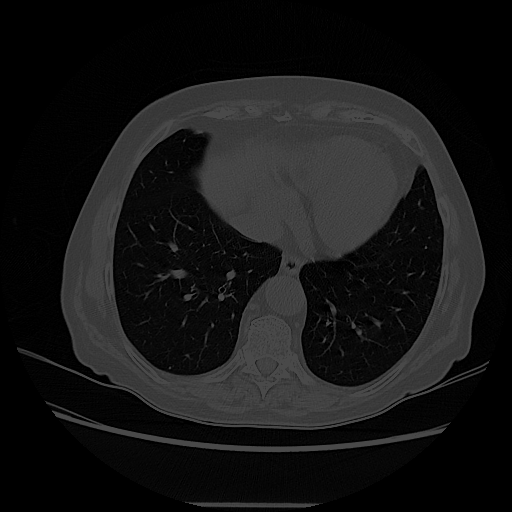 Original NATIVE CT scan (input)