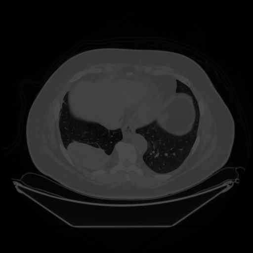 Original NATIVE CT scan (input)