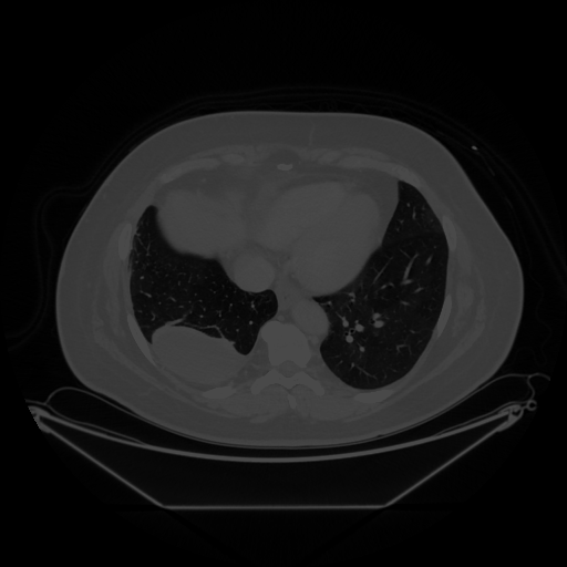Original VENOUS CT scan