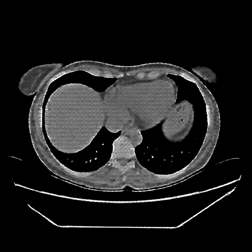 Reconstructed NATIVE CT scan (cycle consistency)
