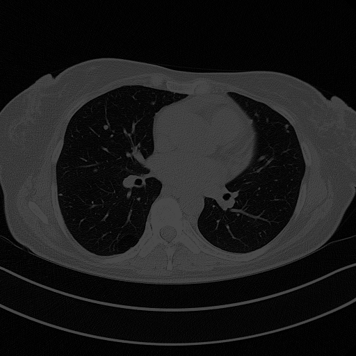 Original NATIVE CT scan (input)