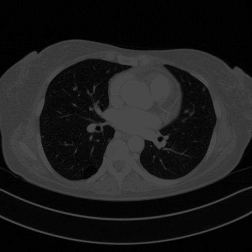 Original VENOUS CT scan