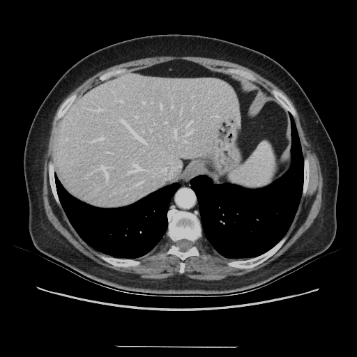 Original VENOUS CT scan