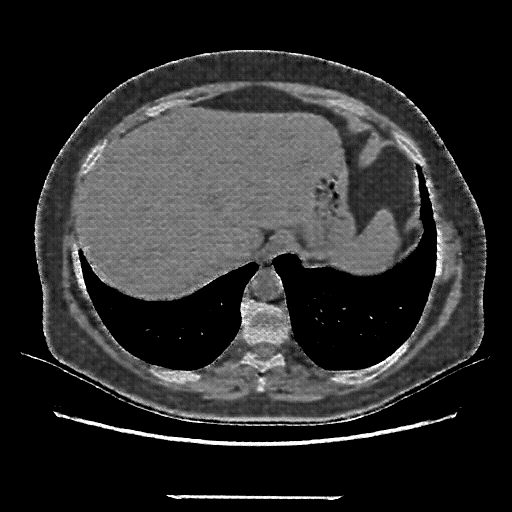 Reconstructed NATIVE CT scan (cycle consistency)