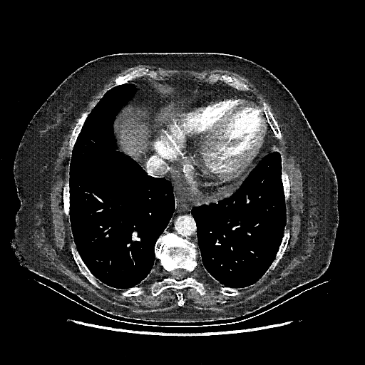Reconstructed NATIVE CT scan (cycle consistency)