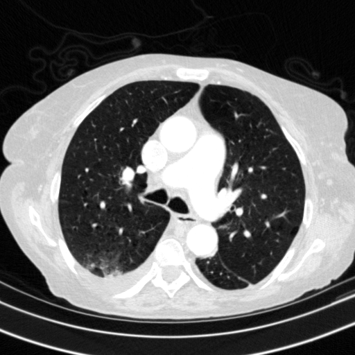 Original VENOUS CT scan