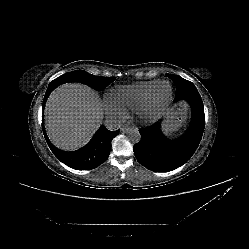 Reconstructed NATIVE CT scan (cycle consistency)
