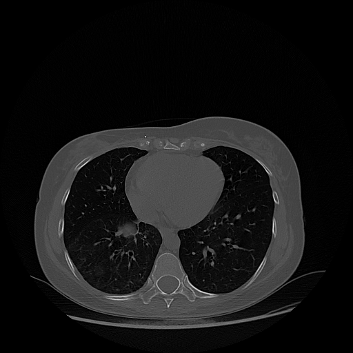 Original NATIVE CT scan (input)