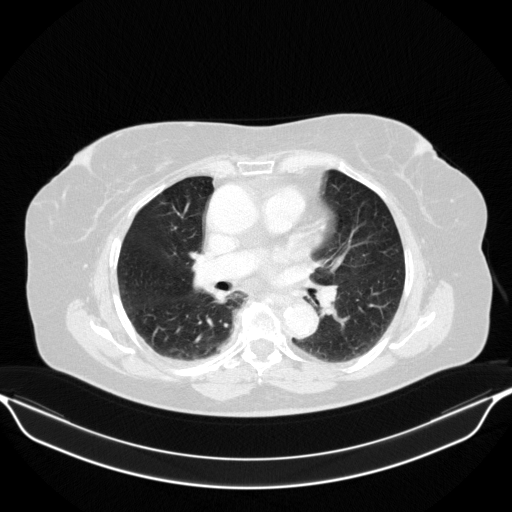 Original VENOUS CT scan