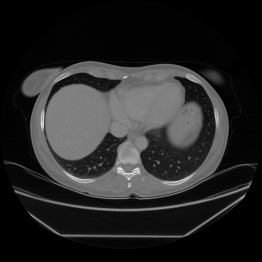Original VENOUS CT scan