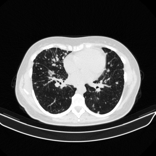 Original NATIVE CT scan (input)