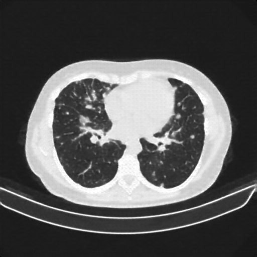 Reconstructed NATIVE CT scan (cycle consistency)