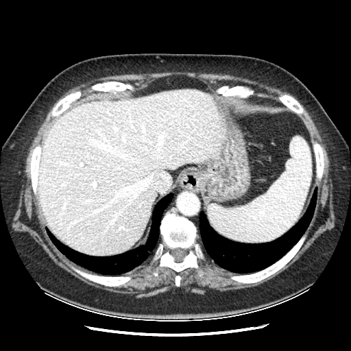 Original VENOUS CT scan