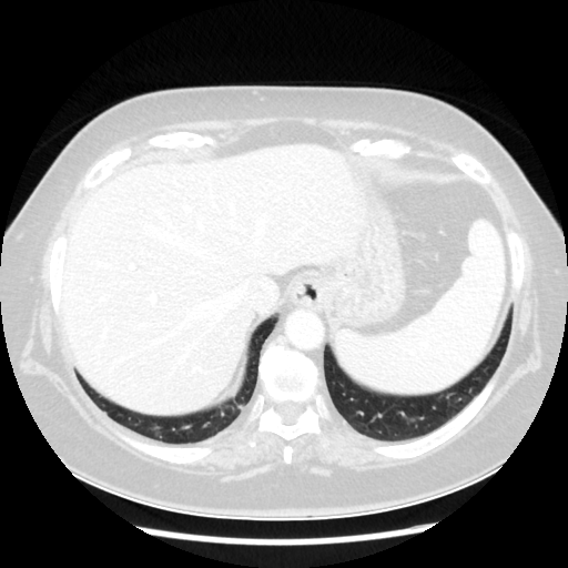 Original VENOUS CT scan