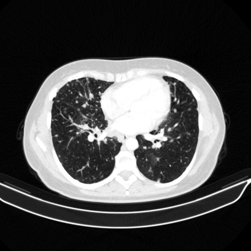 Original VENOUS CT scan
