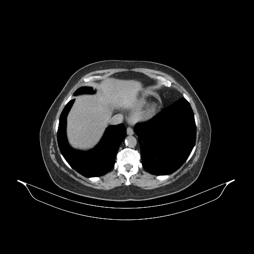 Original NATIVE CT scan (input)