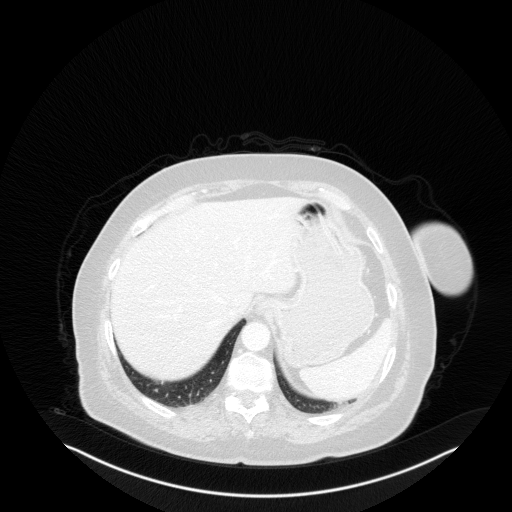 Original VENOUS CT scan