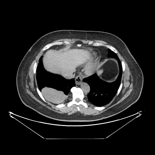 Original NATIVE CT scan (input)