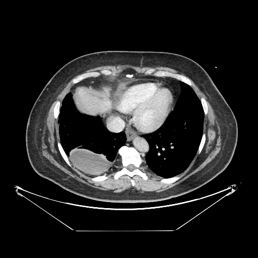 Original VENOUS CT scan
