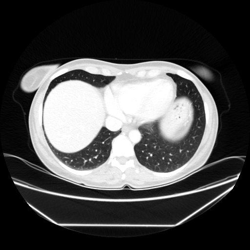 Original VENOUS CT scan