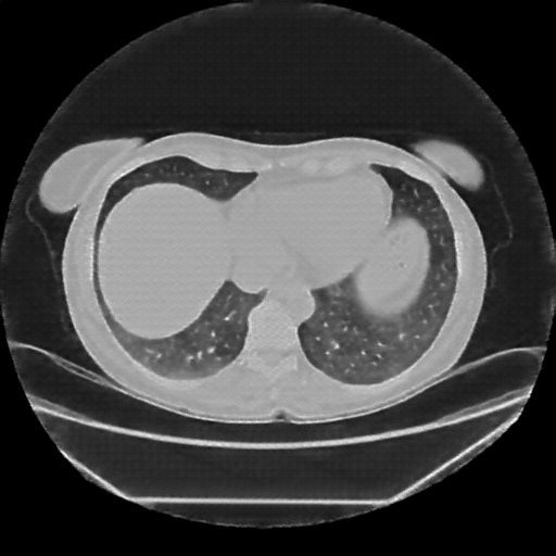 Reconstructed NATIVE CT scan (cycle consistency)