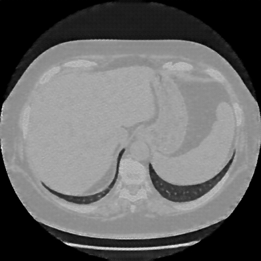 Reconstructed NATIVE CT scan (cycle consistency)