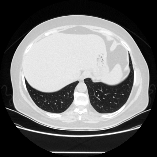 Original NATIVE CT scan (input)