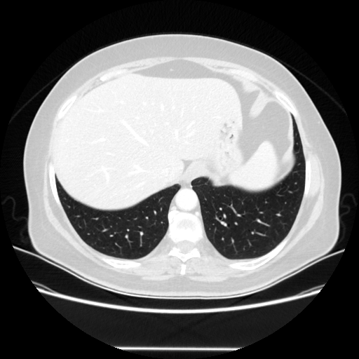 Original VENOUS CT scan