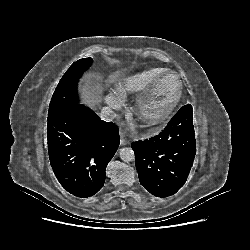 Reconstructed NATIVE CT scan (cycle consistency)