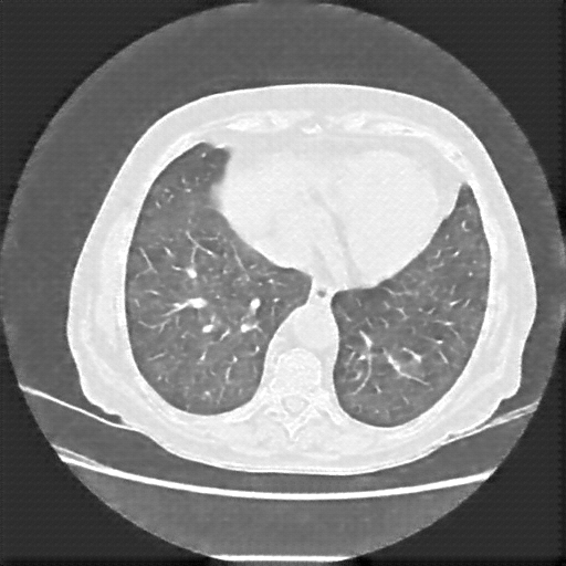 Reconstructed NATIVE CT scan (cycle consistency)