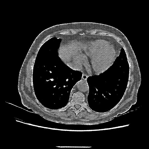 Reconstructed NATIVE CT scan (cycle consistency)