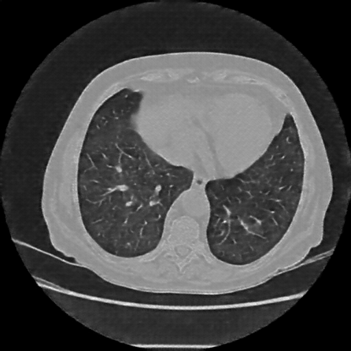 Reconstructed NATIVE CT scan (cycle consistency)