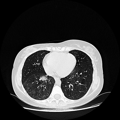 Original NATIVE CT scan (input)