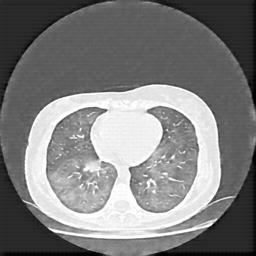 Reconstructed NATIVE CT scan (cycle consistency)