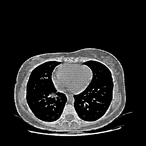 Reconstructed NATIVE CT scan (cycle consistency)