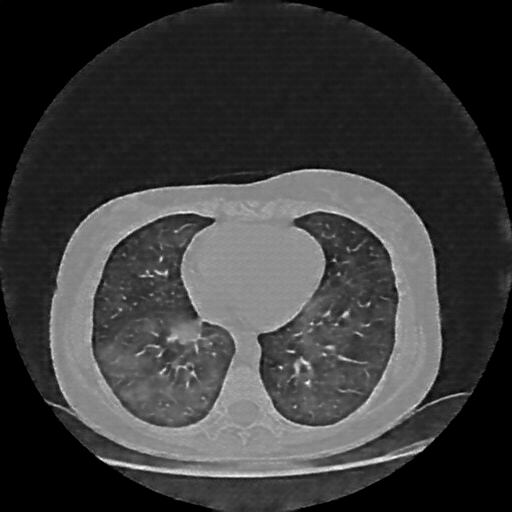 Reconstructed NATIVE CT scan (cycle consistency)