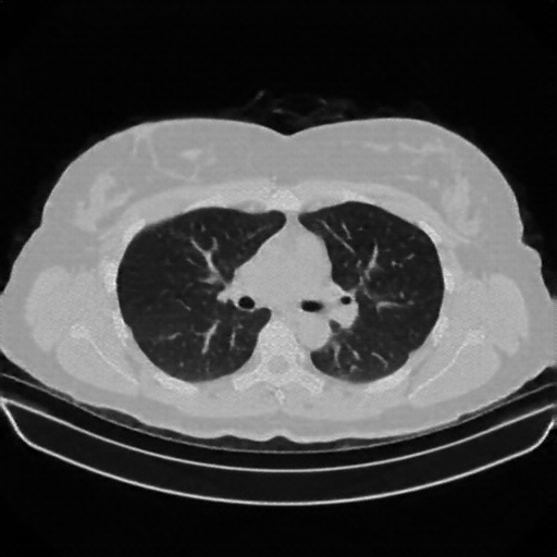Reconstructed NATIVE CT scan (cycle consistency)