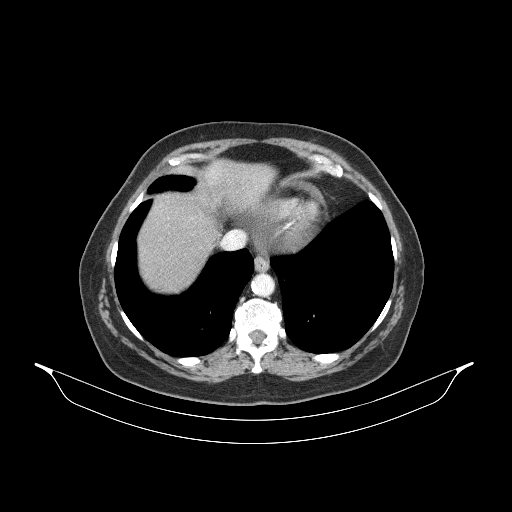 Original VENOUS CT scan
