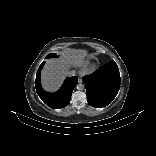 Reconstructed NATIVE CT scan (cycle consistency)
