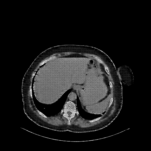 Reconstructed NATIVE CT scan (cycle consistency)