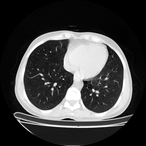 Original NATIVE CT scan (input)