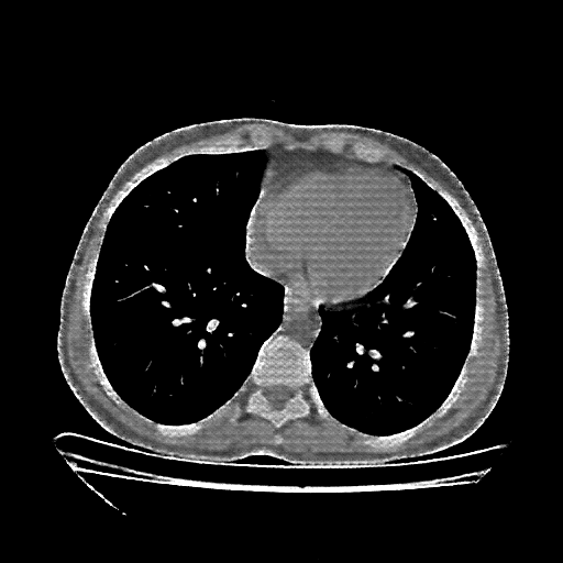 Reconstructed NATIVE CT scan (cycle consistency)