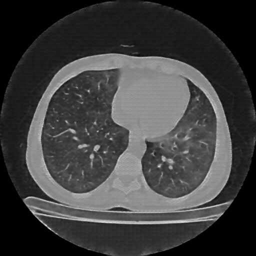 Reconstructed NATIVE CT scan (cycle consistency)