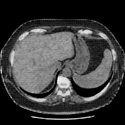 Generated VENOUS CT scan (A→B translation)