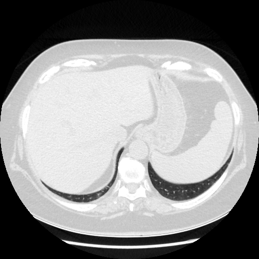 Original NATIVE CT scan (input)