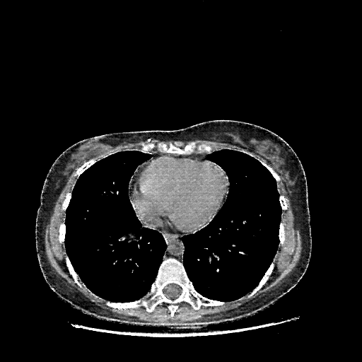 Generated VENOUS CT scan (A→B translation)