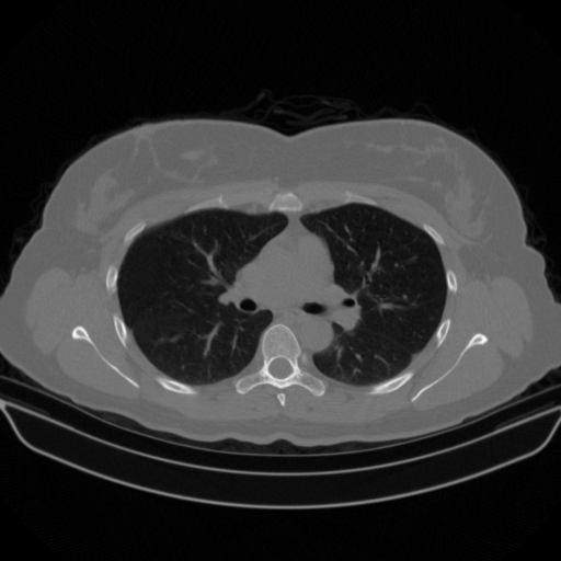 Original NATIVE CT scan (input)