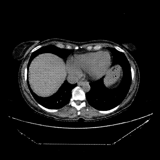 Generated VENOUS CT scan (A→B translation)